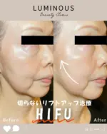 HIFU症例写真

当院ではウルトラセルZiを導入しています。
ドットとリニアの2種類の照射方法を組み合わせることで、コラーゲンの生成や肌のタイトニング効果があり、肌のたるみ改善が期待できます。たるみやしわの改善、フェイスラインの引き締めなどお考えのかたは、一度当院までご相談ください。

#HIFU #ウルトラセルzi  #ルミナスビューティークリニック #美容クリニック  #美容皮膚科　#美容クリニック #群馬県　#太田市 #伊勢崎市 #桐生市 #みどり市 #玉村町 #館林市 #邑楽町 #千代田町 #大泉町 #明和町 #板倉町